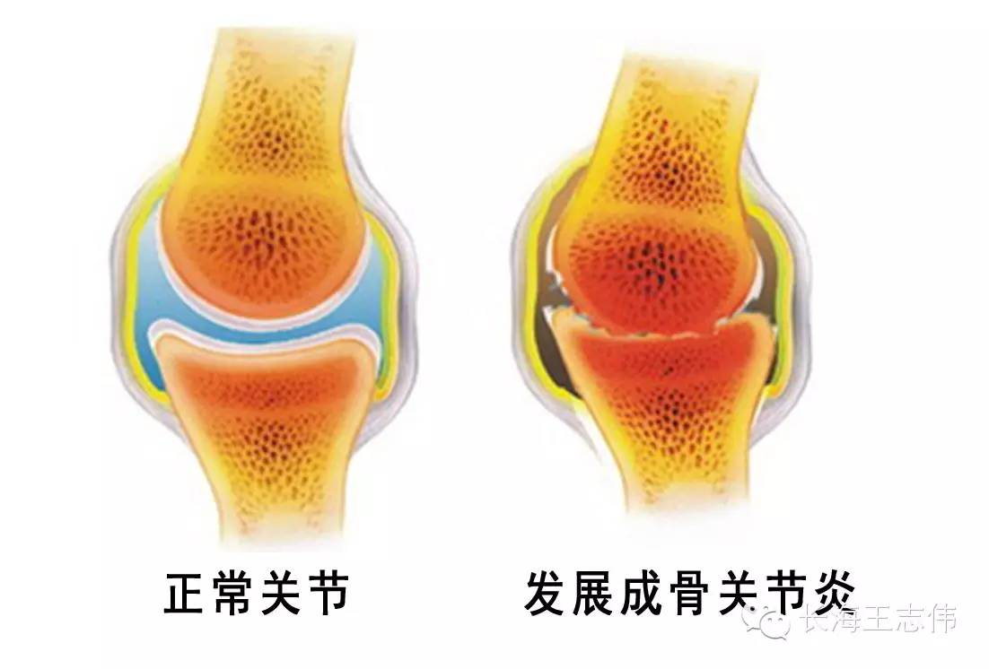 科普关节软骨损伤