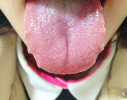 胃炎的症状舌头图片 (49)
