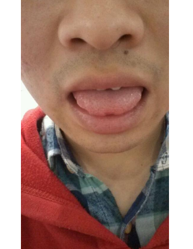 胃炎的症状舌头图片 (51)