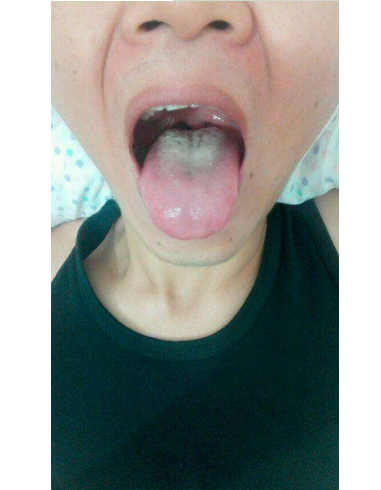 胃炎的症状舌头图片 (9)