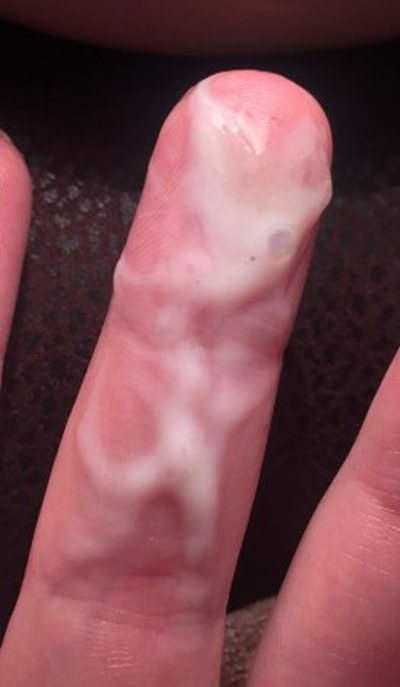 宮頸糜爛二度 (45)
