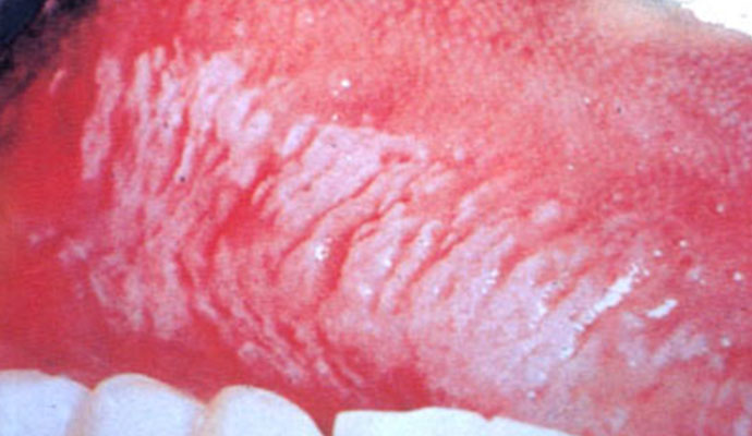 口腔白色念珠菌感染 (45)