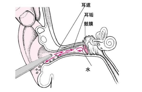 咽鼓管阻塞 (58)