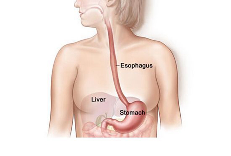 怎么治療食道炎