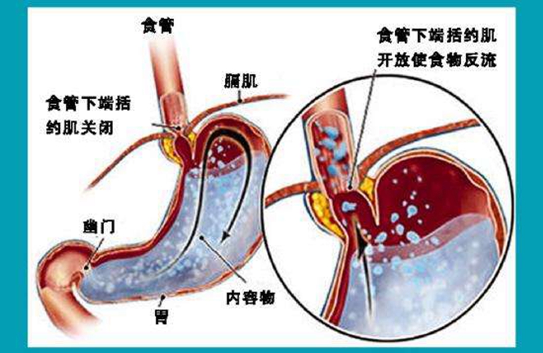 反流性食道炎吧