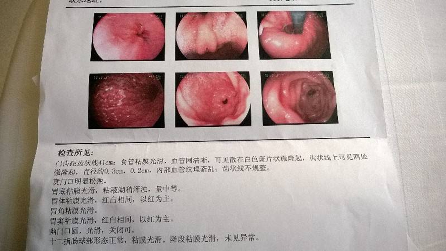 糜爛性食道炎的癥狀