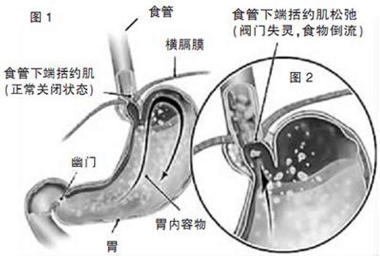 返流性食道炎