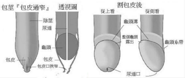 嵌顿包茎自己怎么扩松