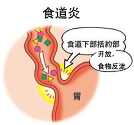 反流性食道炎課件