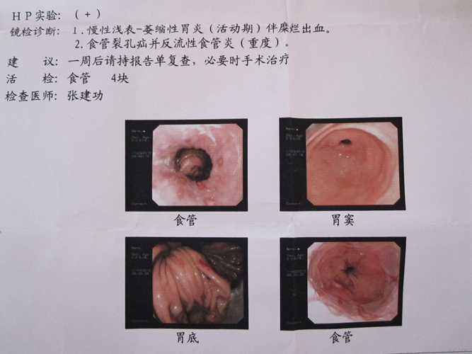 胃炎 食道炎