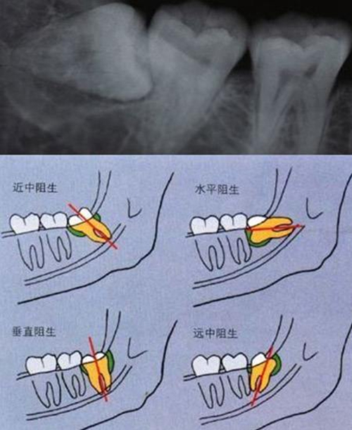 医生检查拔除智齿后回复的图片