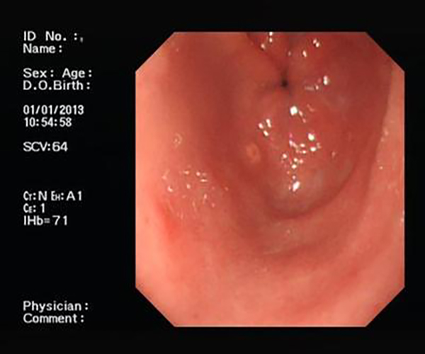 胃鏡下食管炎的癥狀圖片