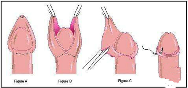 嵌顿包茎要这么治疗