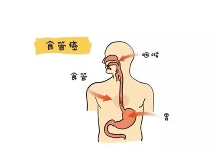 食道癌