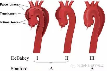 扩展范围局限于升主动脉或主动脉弓;   de bakey iii型:内膜破口位于
