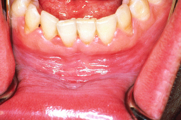 牙龈炎和牙周炎图片(41)