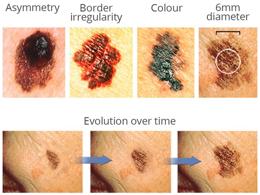 皮肤癌的早期特征图片 (59)