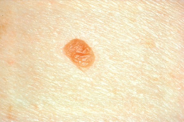 皮肤癌的早期特征图片 (61)