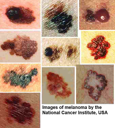 皮肤癌的早期特征图片 (8)