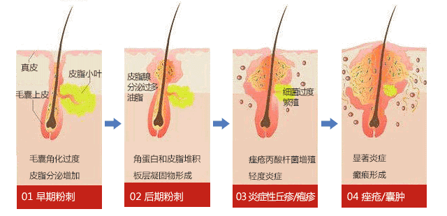 有粉刺怎么办?