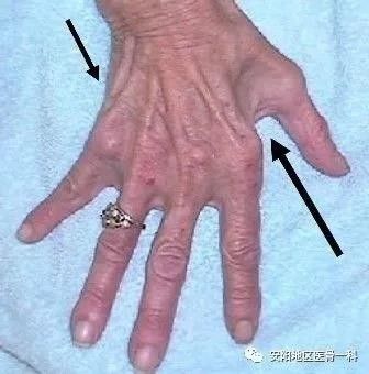 2,tinel's 征:叩击肘部尺侧时,尺侧一个半手指(小指和环指的尺侧)