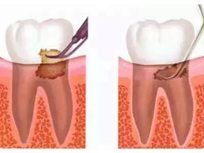 为什么洗牙龈下的牙结石要把牙龈翻开洗?