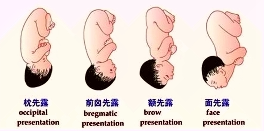 胎方位头位置示意图