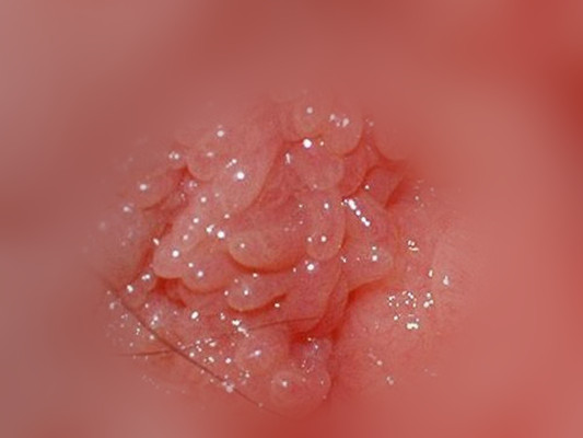 女性生殖器疱疹 (46)