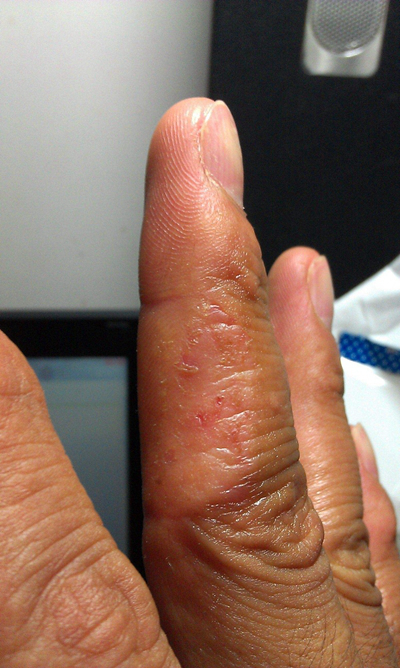 手指湿疹症状图片 (68)