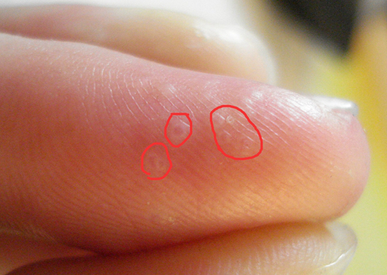 手指湿疹症状图片 (65)