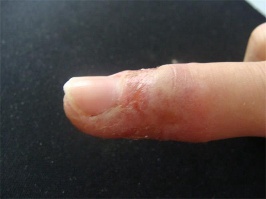 手指湿疹症状图片 (70)