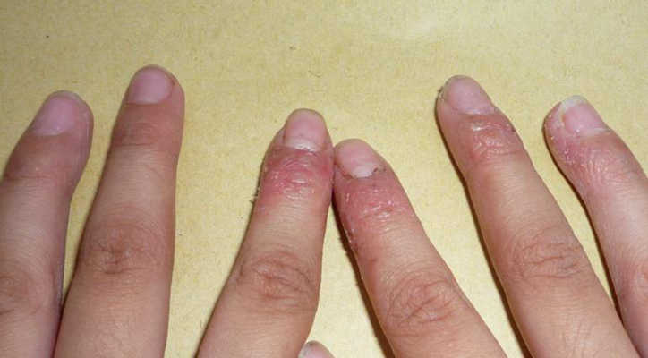 手指湿疹症状图片60