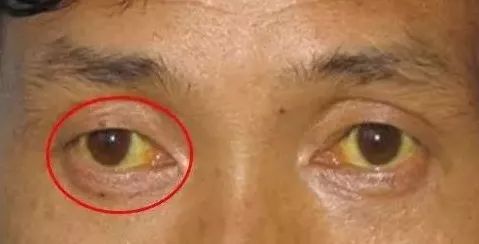 眼睛出现这八种症状,可能是大病征兆