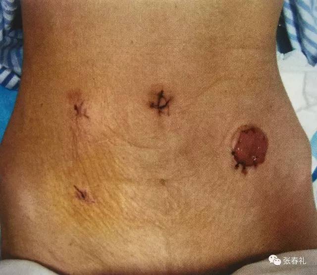 腹腔镜下直肠癌根治术能做的干净吗?_张春礼