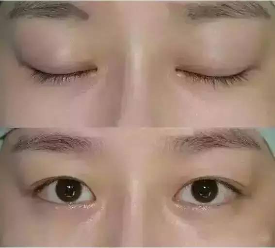 双眼皮 开眼角:美丽人生从眼睛开始