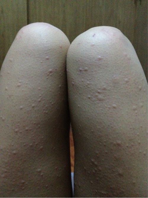 风湿性荨麻疹的症状图片