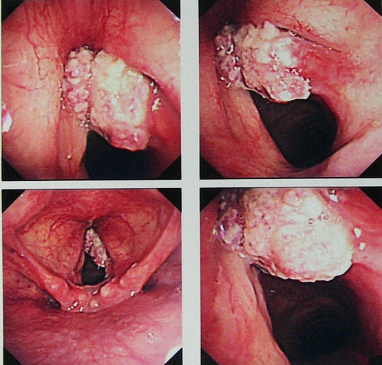 喉癌的临床症状有哪些图片