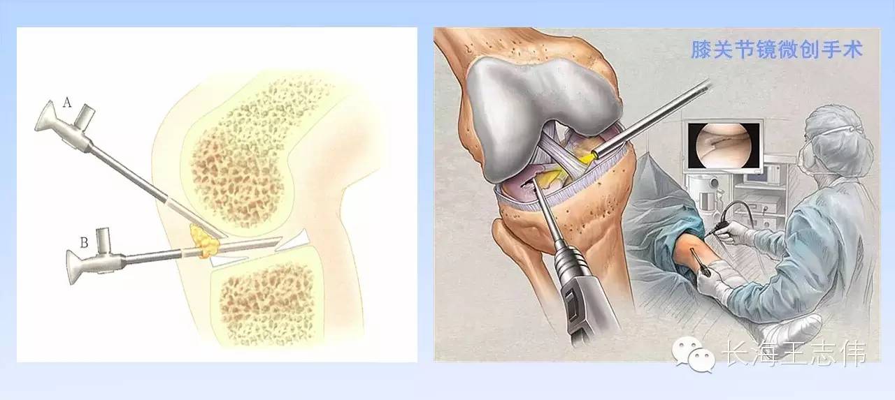 都是月亮惹的祸--半月板损伤