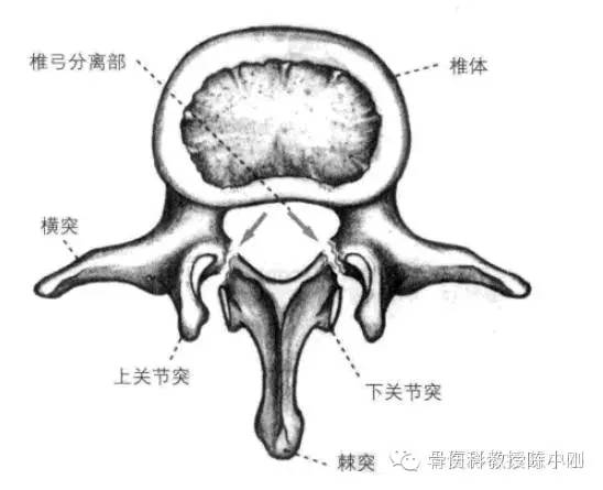 图1中箭头所示"椎弓分离部"即为峡部断裂处.   从图