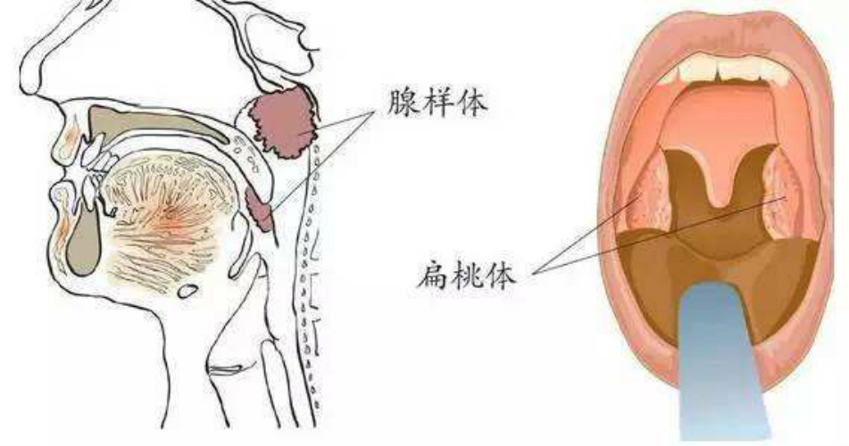 腺样体面容纠正