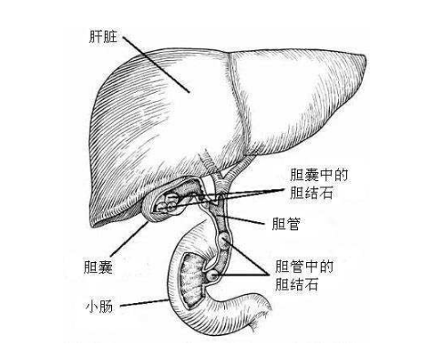 胆结石疼痛部位图 (8)