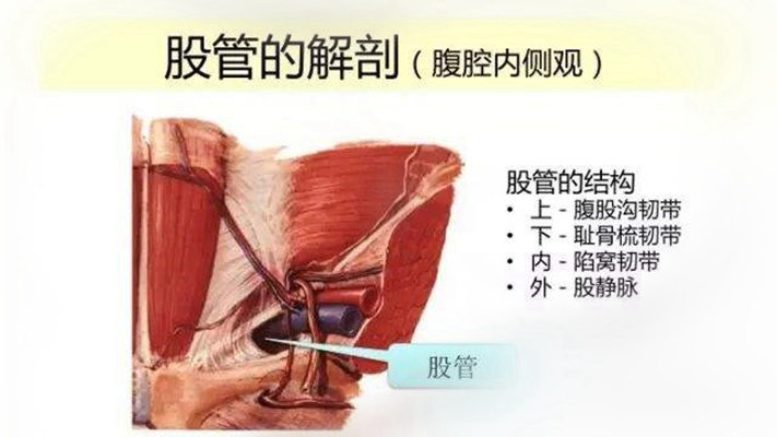 股疝圖片 (3)