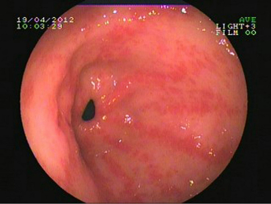 胃癌图片 (82)