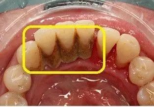 牙齿表面的黑色物质,到底是什么东西?