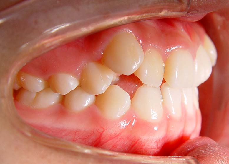 牙龈癌早期症状图片(55)