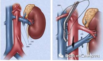 左肾静脉移位术(左图:移位前右图:移位后)