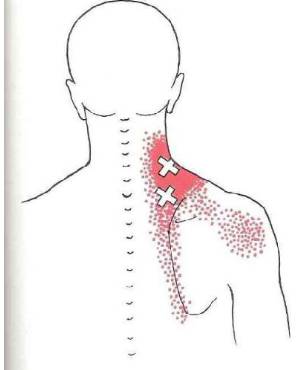 肩胛骨内侧缘疼痛的治疗