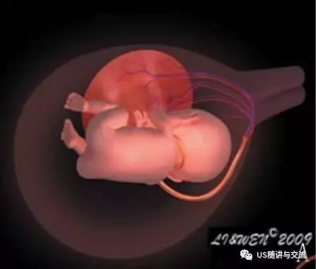 胎儿杀手之帆状胎盘——什么是帆状胎盘?