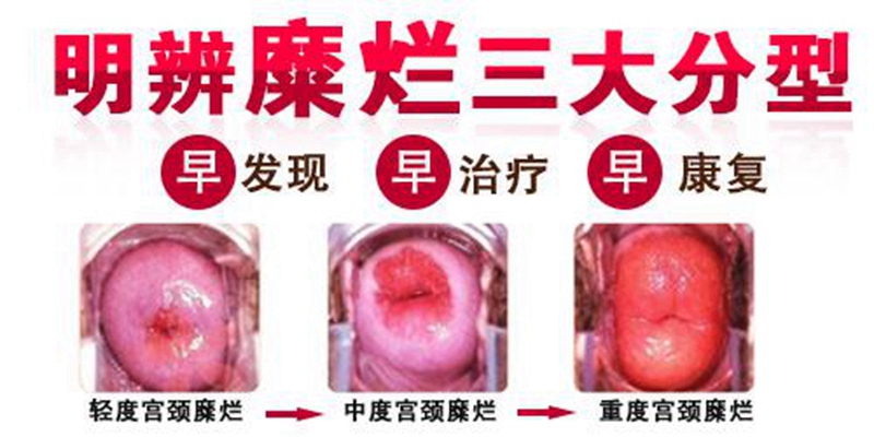 重度宮頸糜爛圖 (19)