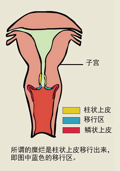 輕度宮頸糜爛圖 (4)